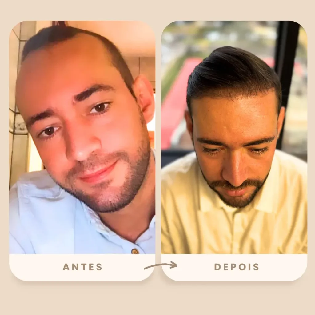 Antes e depois do transplante capilar FUE realizado na Clínica Olimpo Hair - Resultado em paciente jovem mostrando preenchimento na região frontal, com resultado natural e linha capilar bem definida.