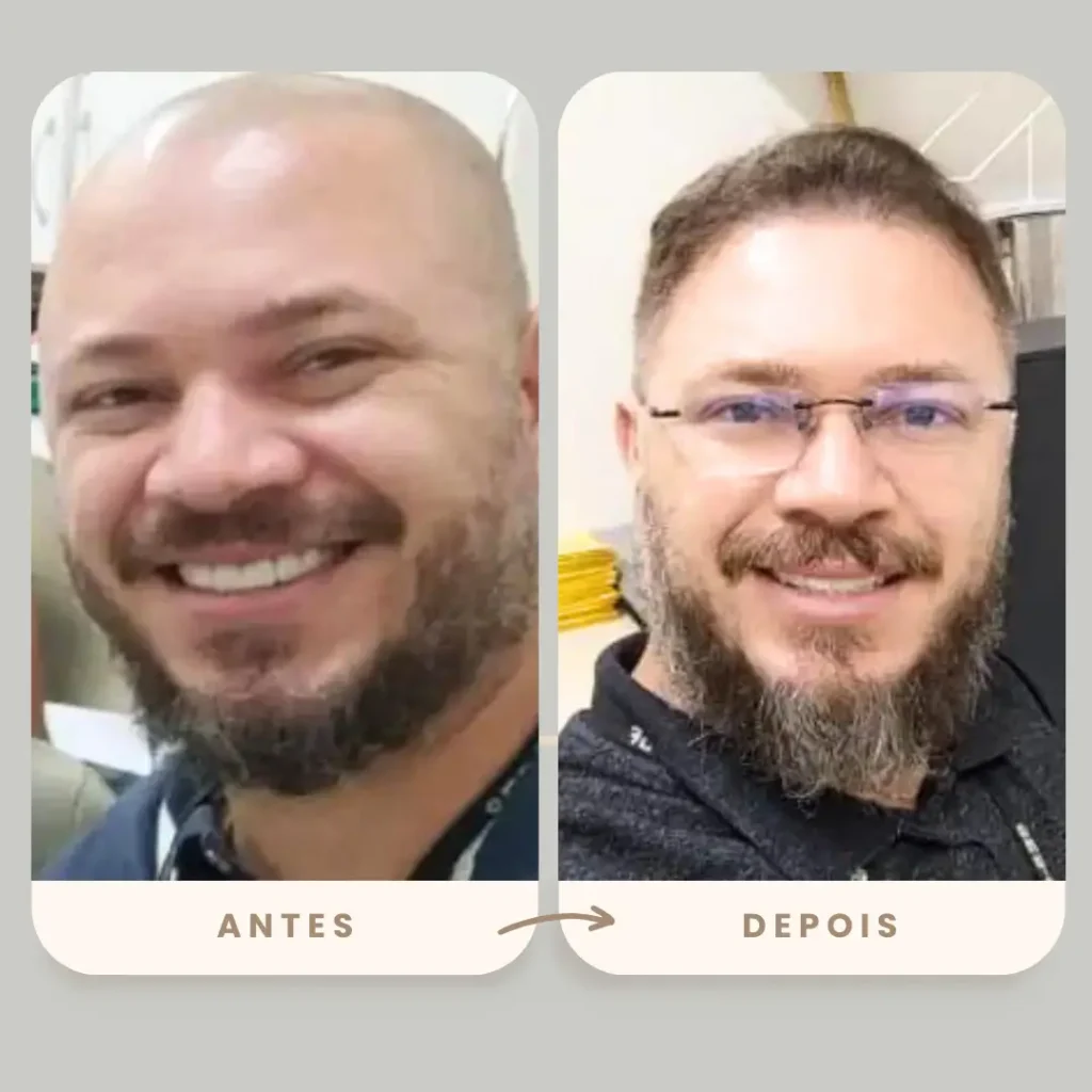 Transformação com transplante capilar FUE na Clínica Olimpo Hair - Paciente com alopecia apresentando excelente resultado no crescimento da barba e densidade capilar após o procedimento.