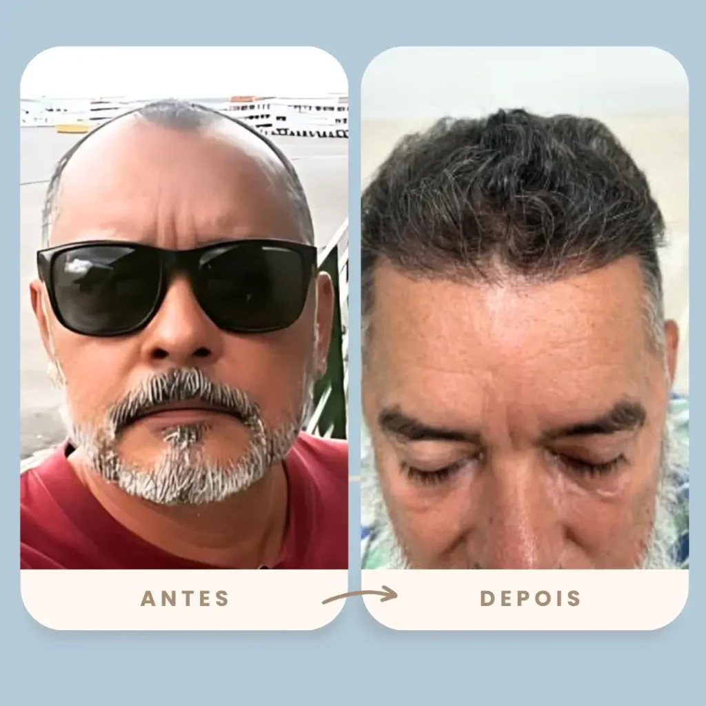 Resultado do transplante capilar FUE da Clínica Olimpo Hair em paciente maduro - Comparativo antes e depois mostrando restauração capilar significativa na região frontal e superior da cabeça.