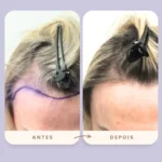 Antes e depois do transplante capilar FUE na Clínica Olimpo Hair - Desenho da linha frontal com marcação em roxo mostrando o planejamento da intervenção e o resultado final natural após o procedimento.