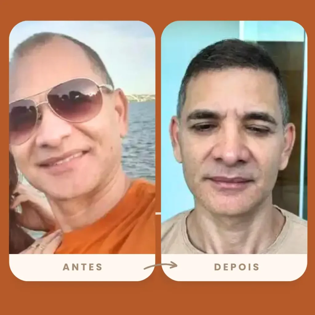 Resultado de transplante capilar FUE realizado na Clínica Olimpo Hair - Comparativo mostrando a transformação em paciente com alopecia, apresentando preenchimento natural e densidade adequada na região frontal.