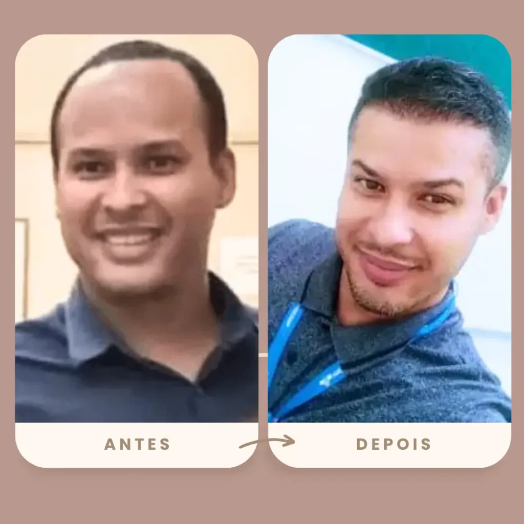 Antes e depois do transplante capilar FUE da Clínica Olimpo Hair - Paciente jovem apresentando expressiva melhora na densidade capilar e linha frontal após o procedimento, com resultado natural